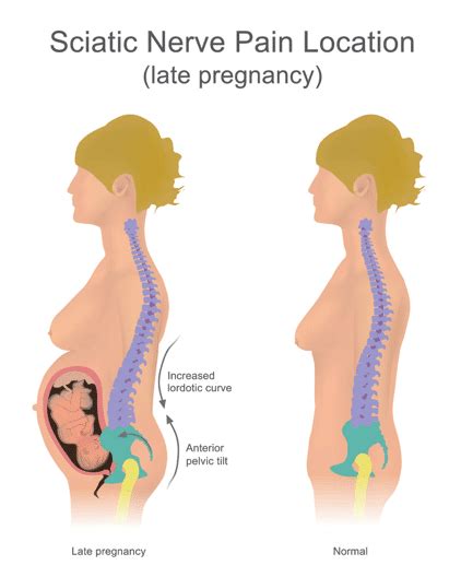 Back Pain During Pregnancy Treatment Causes And Diagnosis Qi Spine