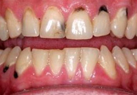 how do you distinguish between a coffee stain on your teeth and a cavity