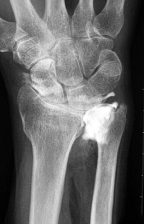 A tfcc injury typical presents with ulnar sided wrist pain and can result in a distal radioulnar joint (druj) injury. Positive ulnar variance with TFCC tear | Image ...