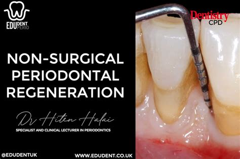 Dentistry Cpd Video Non Surgical Periodontal Regeneration