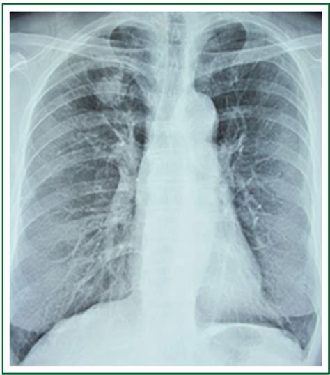Early Diagnosis Of Solitary Pulmonary Nodules Xu Journal Of