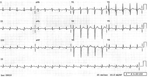 Patient 2 A 12 Lead Electrocardiogram Shows St Segment Elevation In