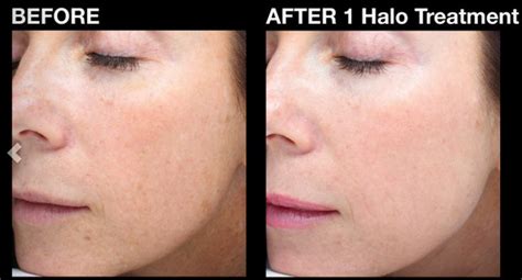 Halo Laser Treatment Before And After Grabillroegner 99