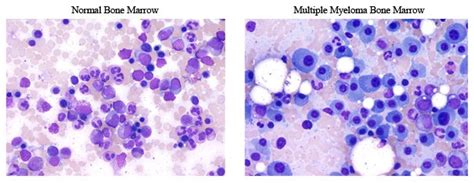 Multiple myeloma