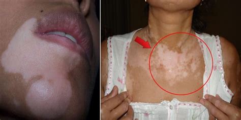 Do You Have White Spots On Your Skin Heres What They Are And How To Treat Them