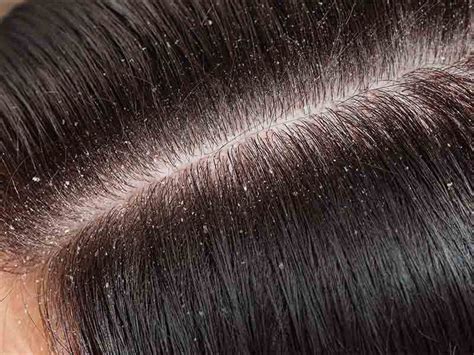 Repeated stress to the scalp will cause hair loss. No more embarrassment due to dandruff and itchy scalp ...