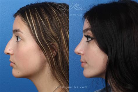 What Is External Rhinoplasty Philip Miller Md