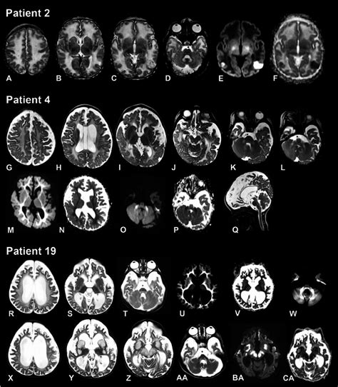 Magnetic Resonance Imaging Of The Brain From Patient 2 4 Days