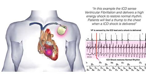 Implantable Cardioverter Defibrillator Icd General Information