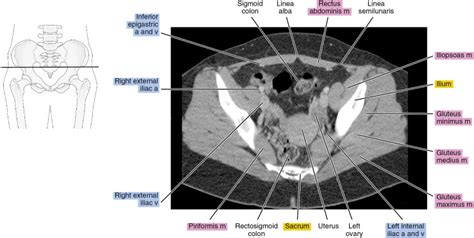 Ct Anatomy Pelvis Scan Muscle Pelvic Axial Iliacus Bone Labeled The