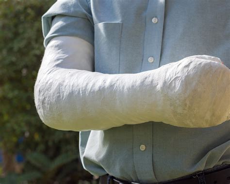 Amputation injury compensation – Unite Legal Services