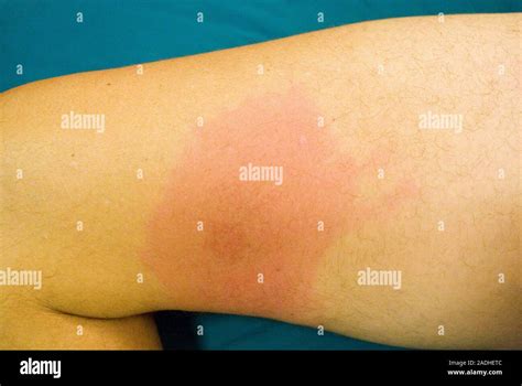 Model Released Erythema Migrans Rash This Rash Seen Here Affecting A
