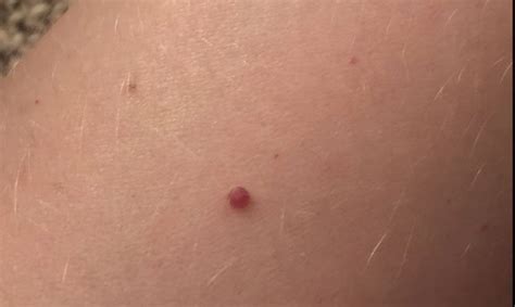 Ask Dr Cohn What Are Cherry Angiomas Your Great Skin