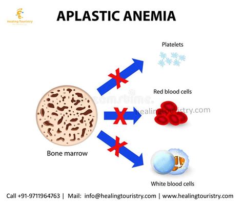 Pin On Aplastic Anemia Treatment