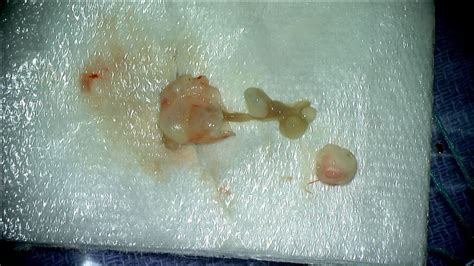Once the tapeworm eggs are in a person's body, the larvae infect the muscles and brain, causing cysts. Surgeons Opened a Patient's Skull to Remove Cancer, And ...