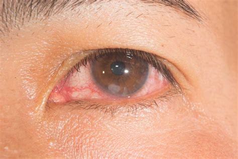 What Is A Corneal Ulcer Eye Health Central