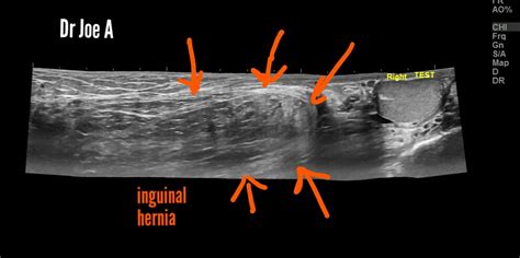 Ultrasound Imaging Inguino Scrotal Hernia