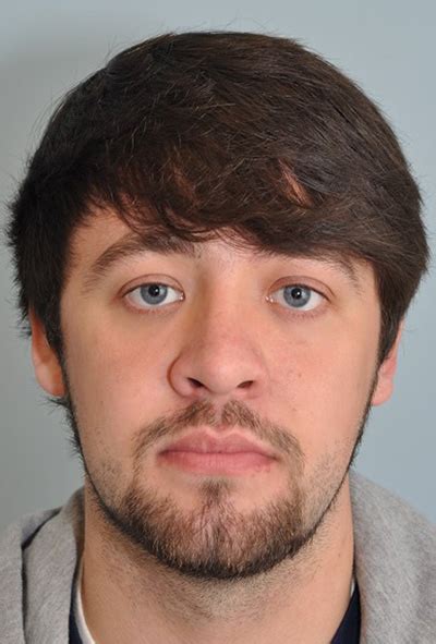 Welcome to stanton optical ridgeland. Rhinoplasty Case 1548 - Faces, PLLC in Ridgeland, MS