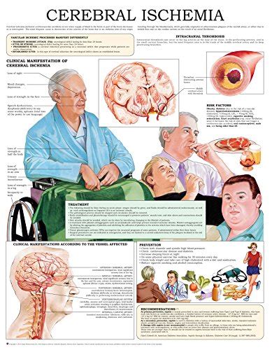 Cerebral Ischemia E Chart Quick Reference Guide Ebook Hc Healthcomm Kindle Store