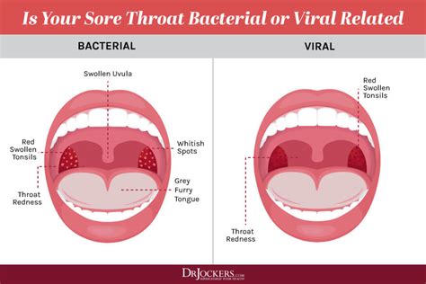 Viral Inflamed Tonsils