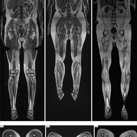 Whole Body Mri Scans T1 Weighted Images And Transverse Sections Of