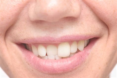 A Few Important Facts About Crooked Teeth Woodland Hills Ca