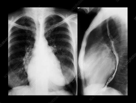 Enlarged Heart X Rays Stock Image M1720599 Science Photo Library