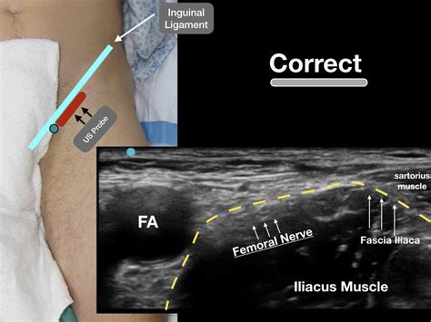 Femora Nerve Block Highland Em Ultrasound Fueled Pain Management