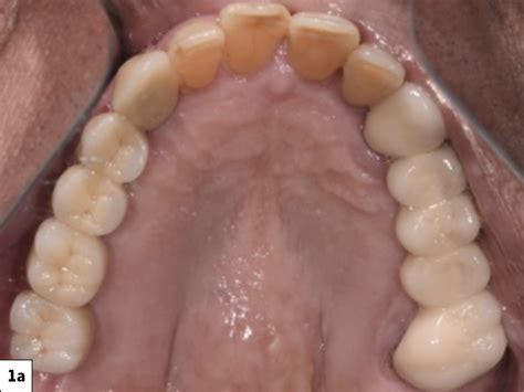 Tilted Implants In The Partially Edentulous Maxilla