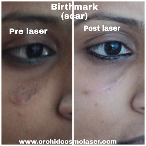 Before After Images Of Scar Treatment Orchid Cosmo Laser