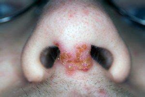 Impetigo on Face, Scalp, Nose, Mouth, Lips, Eyes, Ears ...