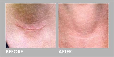 Keloid Scar Removal Before And After Images And Photos Finder