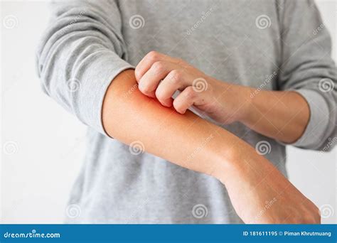 Asian Man Itching And Scratching On Arm From Itchy Dry Skin Eczema
