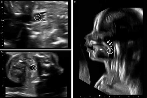 The ‘equals Sign A Novel Marker In The Diagnosis Of Fetal Isolated
