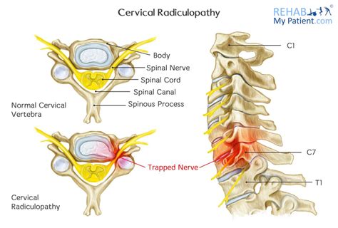 Cervical Radiculopathy Pinched Nerve Rehab My Patient