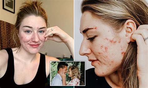 Woman With Cystic Acne Feared She Was Unlovable Due To Scarred Skin