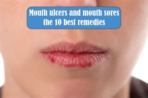 Mouth Ulcers And Mouth Sores The 10 Best Remedies