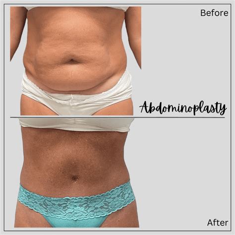 What Will Happen To My Belly Button During A Tummy Tuck Board Certified Cosmetic Surgeon