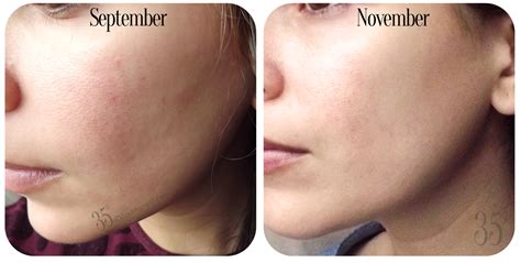 OST Original Pure Vitamin C20 Serum Review | Entering 35th ...