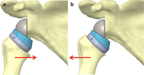 Effect Of Humeral Stem Design On Humeral Position And Range Of Motion