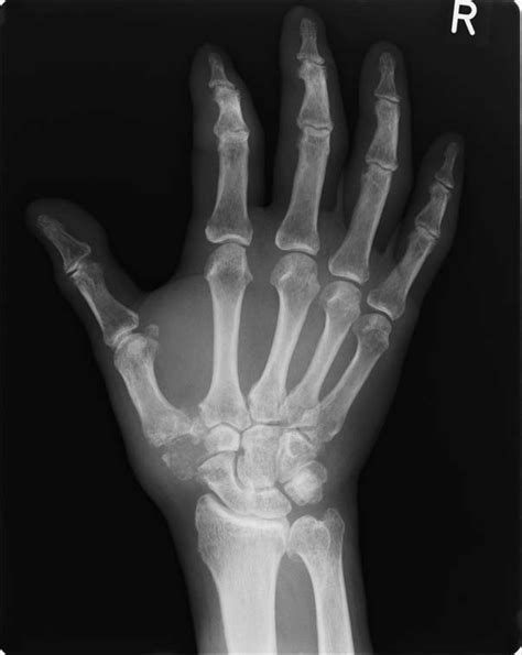 X Ray Image Of The Right Hand At The Initial Visit The Patient Had An