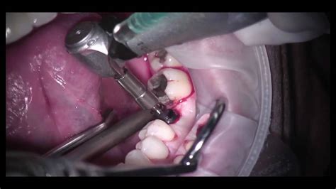 Guided Dental Implant Surgery Part 2 Youtube