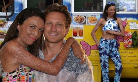 Burns Survivor Turia Pitt Gushes About Fiance Michael Hoskin Daily Mail Online
