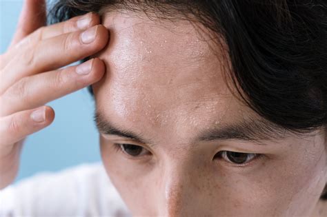 Forehead Bumps And Pimples Causes And How To Treat