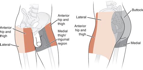 Here's how to treat it. Hip Pain | Diagnosis for Physical Therapists: A Symptom-Based Approach | F.A. Davis PT ...
