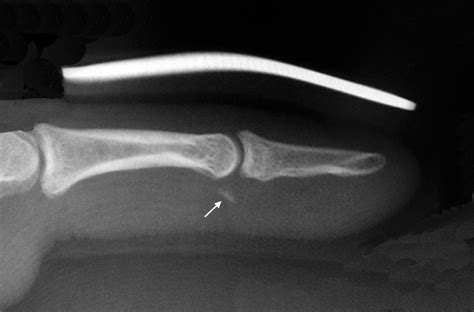 Dislocation Finger Distal Interphalageal Dip Joint Hand Surgery