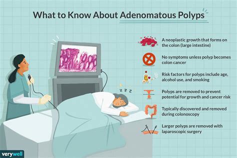 Polype Adénomateux Symptômes Causes Diagnostic Et Traitement
