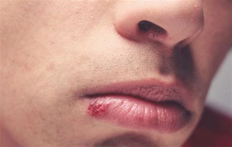 How To Detect Prevent And Treat Herpes Mens Health
