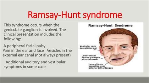 Ramsay Hunt Syndrome Syndrome Oral Pathology Ramsay