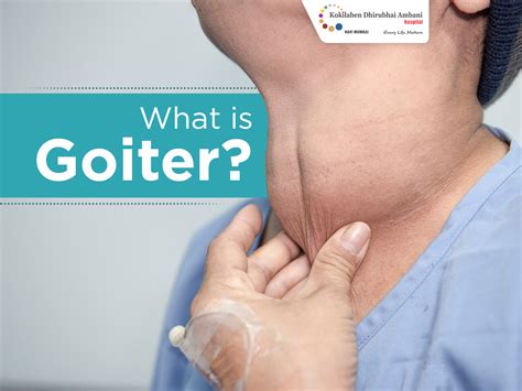 What Is Goiter